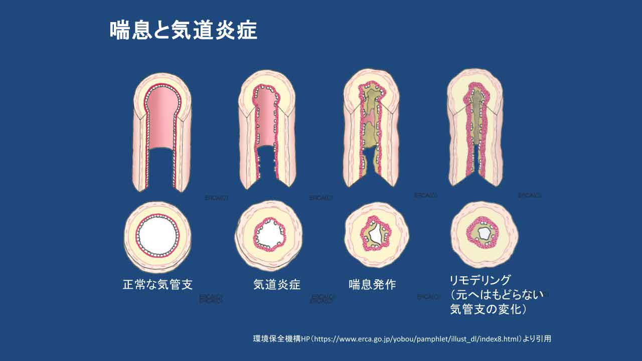 喘息の気道イメージ図