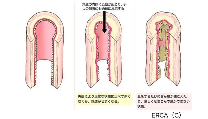 正常な気道、気道炎症が進んだ気道、そして重度の喘息発作時の気道の縦断面図。気道内の変化とその影響がわかりやすく示されています。