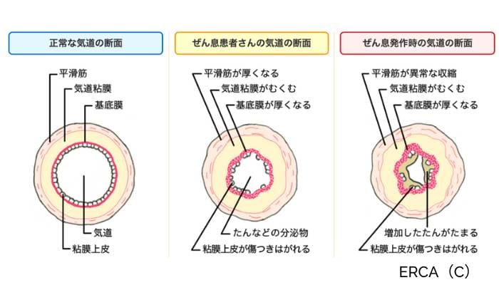 正常な気道、喘息患者の気道、喘息発作時の気道の断面図。気道の状態がどのように変化するかを示しています。