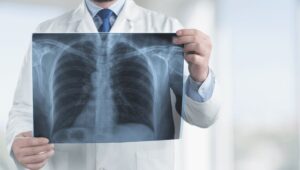 医師が胸部レントゲン画像を持って肺の健康状態を説明している様子