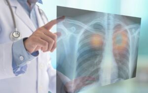 胸部レントゲン画像を指し示しながら説明する医師の写真。肺の影や炎症を確認する様子のイメージ。